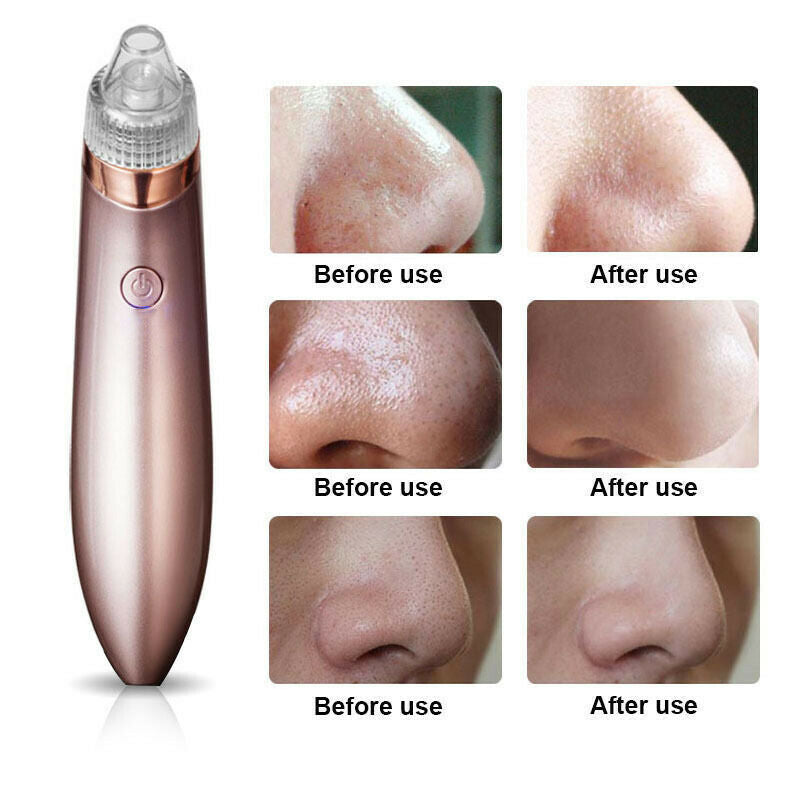 "Revitalize your skin with our Electric Blackhead Vacuum Pore Cleaner. Say goodbye to acne and blackheads!"